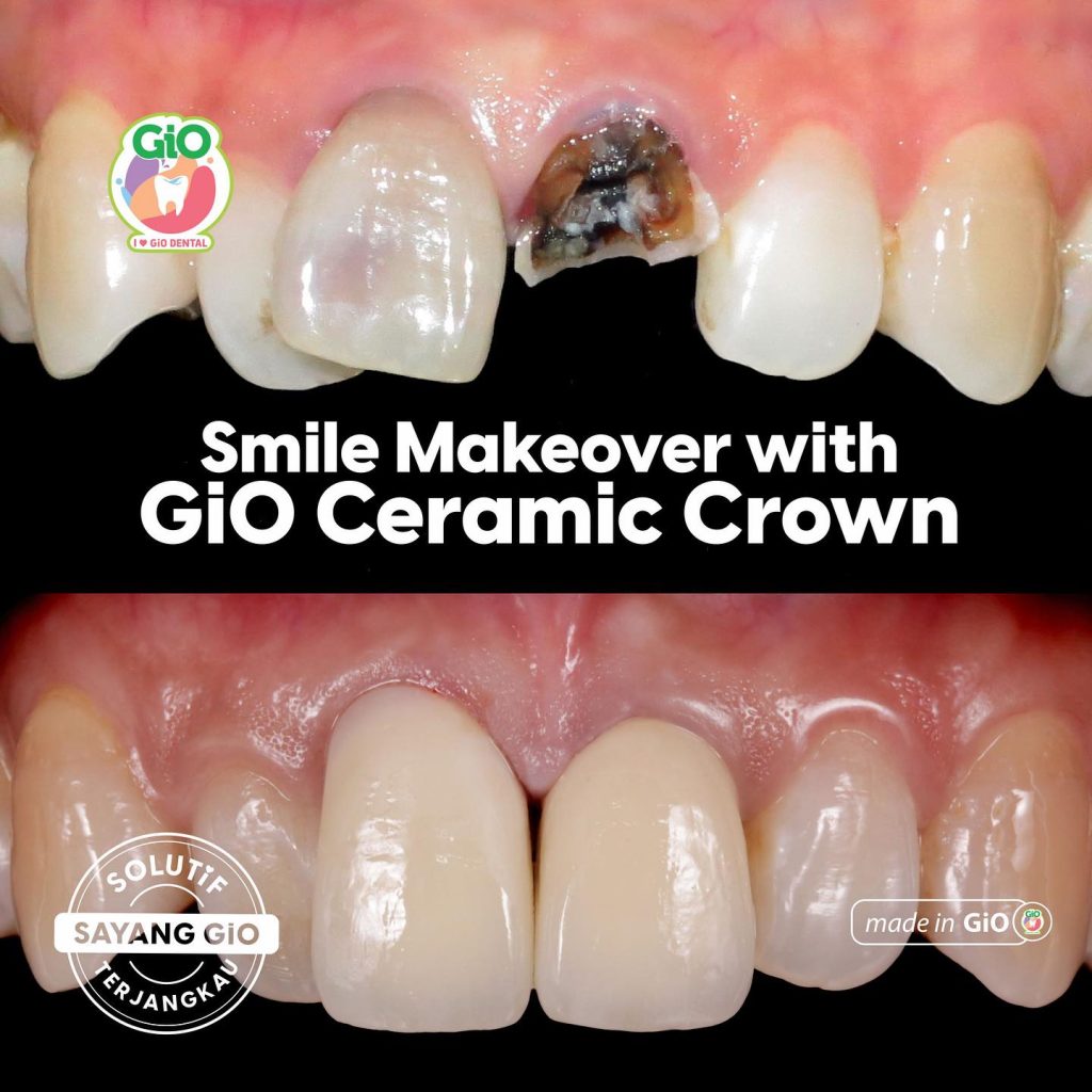 ceramic crown smile makeover